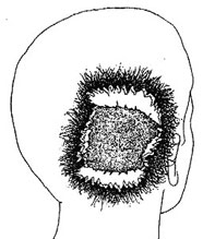 JFK’s head wound as described by Dr. McClelland (ARRB MD #264)